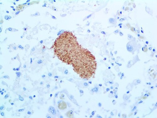 IHC of Pneumocystis Jirovecii on an FFPE Infected Lung Tissue